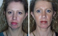 Facelift with Chin Implant, Dermabrasion