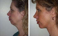 Facelift with Chin Implant, Dermabrasion