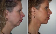 Facelift with Chin Implant, Dermabrasion