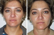 Neck Lift and Chin Implant