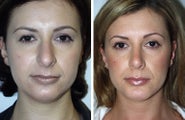 Neck Lift and Chin Implant