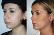 Neck Lift and Chin Implant
