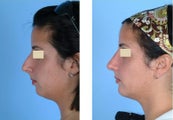 Rhinoplasty and Chin Implant
