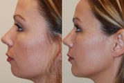 Chin Implant, profile view