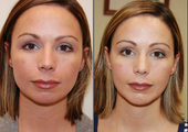 Chin Implant, frontal view
