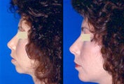 Chin Augmentation