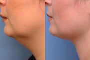 Chin liposuction