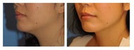 Chin Liposuction