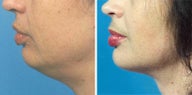Chin Liposuction