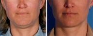 Chin Liposuction