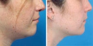 Chin Liposuction