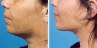 Chin Liposuction