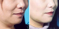 Chin Liposuction