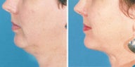 Chin Liposuction