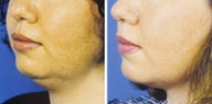 Chin Liposuction