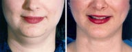 Chin Liposuction