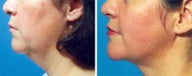 Chin Liposuction