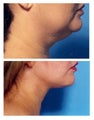 Chin Liposuction