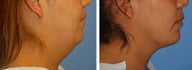 Chin Liposuction
