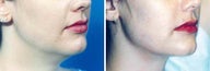 Chin Liposuction