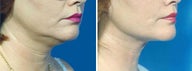 Chin Liposuction