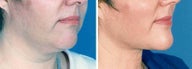 Chin Liposuction