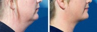 Chin Liposuction