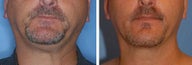 Chin Liposuction