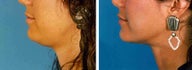 Chin Liposuction