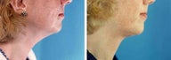 Chin Liposuction