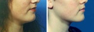 Chin Liposuction