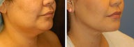 Chin Liposuction