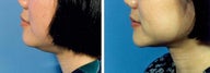 Chin Liposuction