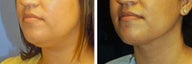 Chin Liposuction
