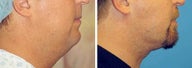 Chin Liposuction