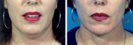 Chin Liposuction