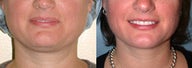 Liposuction (chin and jaw line)