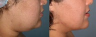 Liposuction (chin and jaw line)
