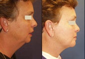 Chin Augmentation