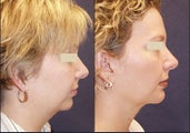 Chin Augmentation