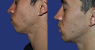 Chin Augmentation