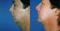 Chin Augmentation