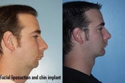 Chin Implant, Facial Liposuction
