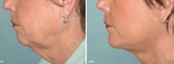 Chin Implant with Facelift