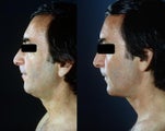 Chin Implant and Neck Liposuction