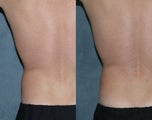 Zeltiq for fat reduction on "love handles"