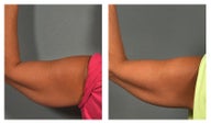 CoolSculpting