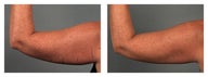 CoolSculpting Arms