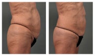 CoolSculpting Abdomen