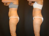 CoolSculpting